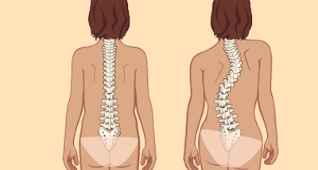 A escoliose como causa de osteocondrose lumbar