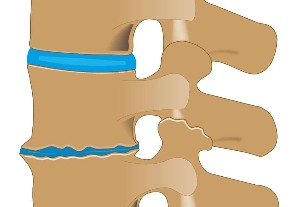 Danos no disco con osteocondrose