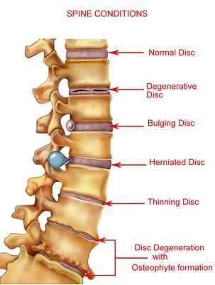 Grao de osteocondrose