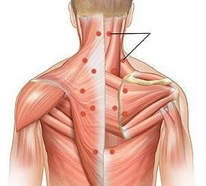 A miosite como causa de dores nas costas