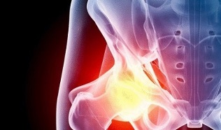 Causas do desenvolvemento da artrose da cadeira