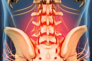 Causas e síntomas da osteocondrose