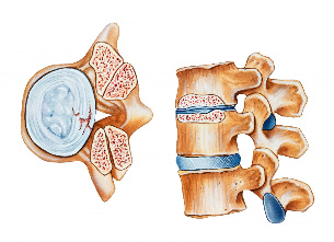 Osteocondrose