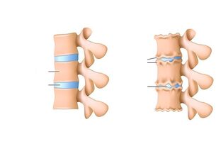 Osteocondritis da columna vertebral