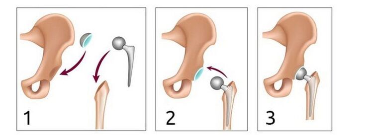 Artroplastia de cadeira