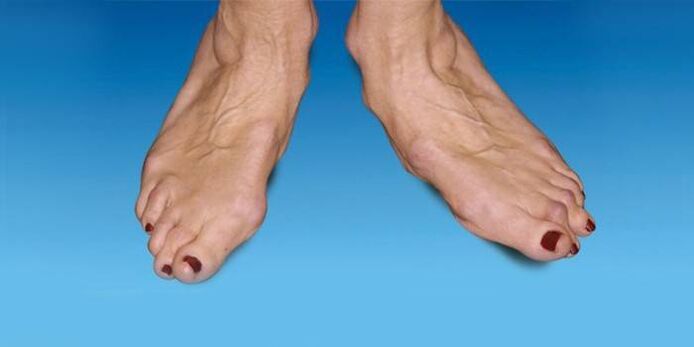 Malposición do pé na artrose do nocello