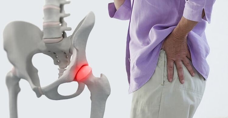 Dor na cadeira síntoma da artrose na articulación da cadeira