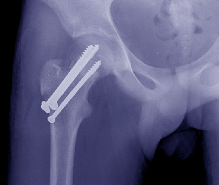 Radiografía da articulación da cadeira, osteosíntese da fractura con fixadores internos
