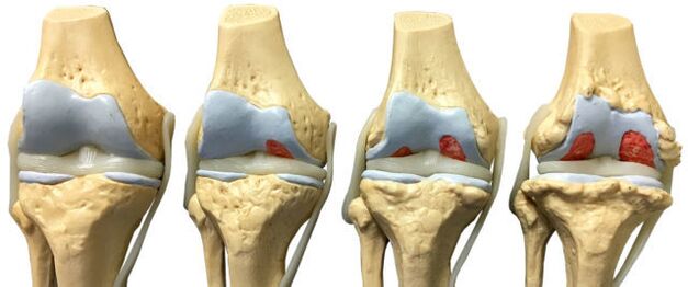 Danos nas articulacións en varias etapas do desenvolvemento da artrose do nocello