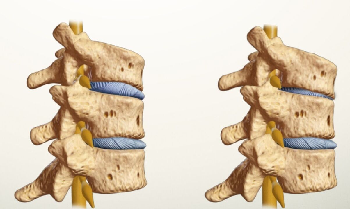 columna vertebral san e enferma con osteocondrose lumbar