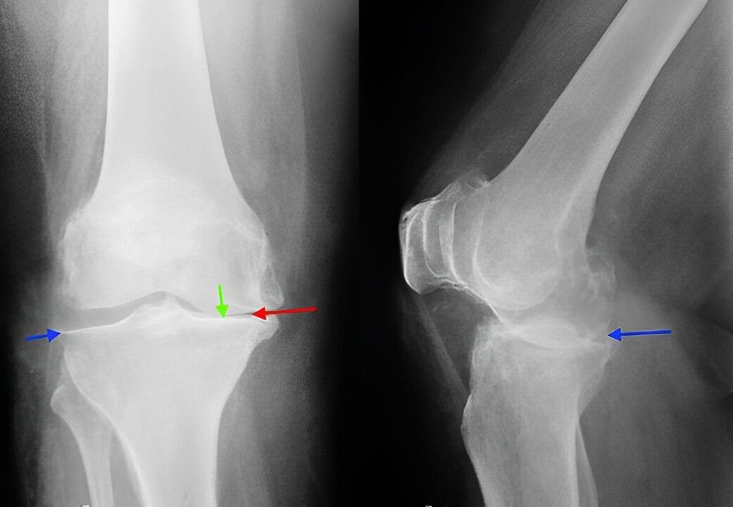 Imaxe de raios X da artrose da articulación do xeonllo