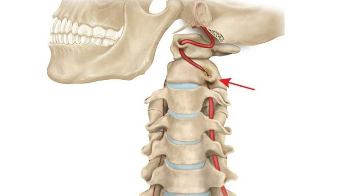 Osteocondrose da columna cervical