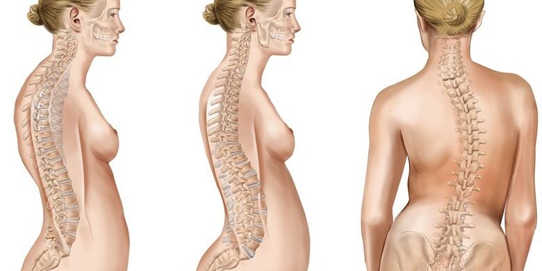 A escoliose da columna torácica provoca dor nos omóplatos
