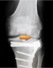 Osteoartrite da articulación do xeonllo